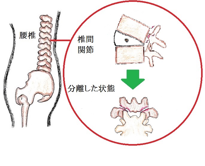 腰椎が倒れると椎関節同士がぶつかって疲労骨折するのです