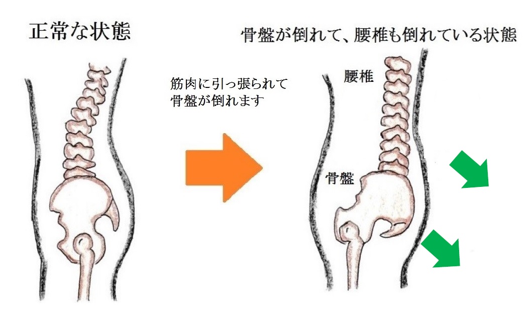 腰椎が倒れると椎間関節同士がぶつかって疲労骨折する