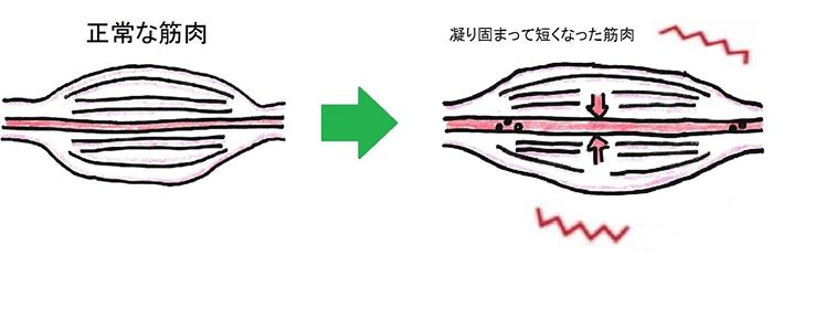 アキレス腱炎筋肉