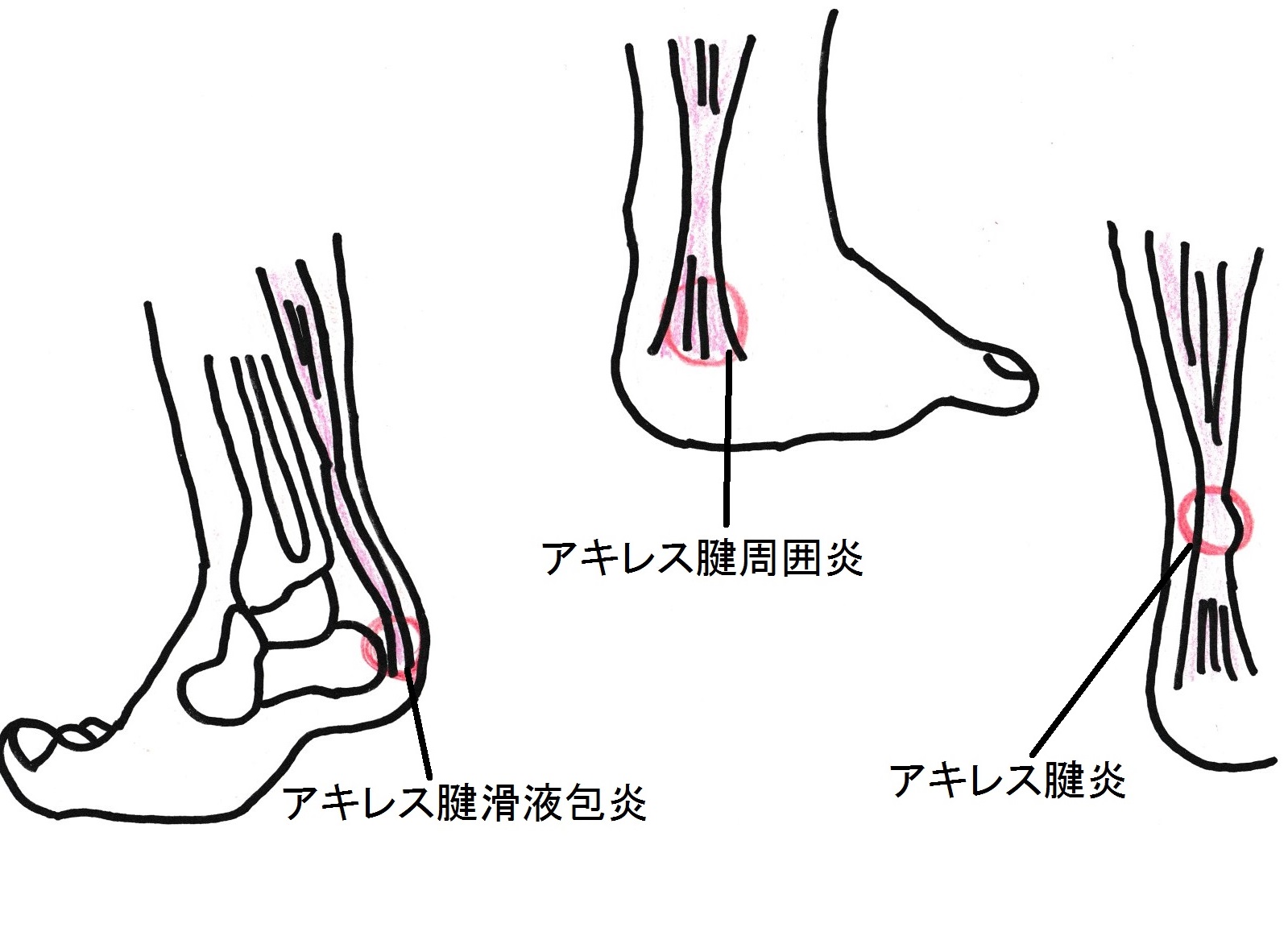 アキレス腱炎や周囲炎になる原因とは？