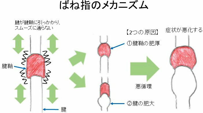 ばね指メカニズム