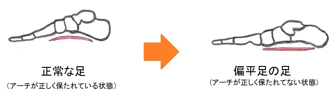 自宅で足のアーチを保持するトレーニング法