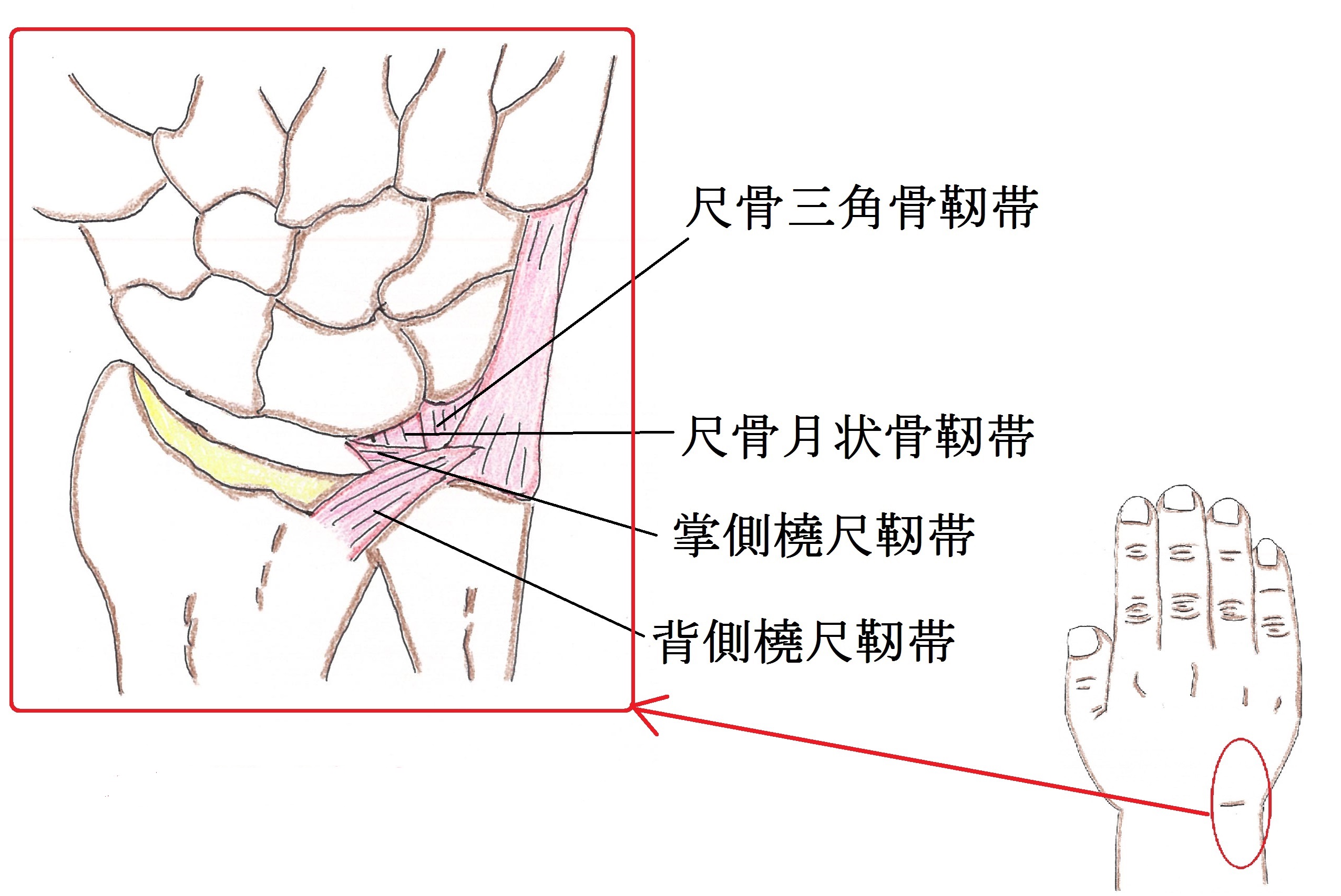 TFCC(三角線維軟骨複合体)損傷