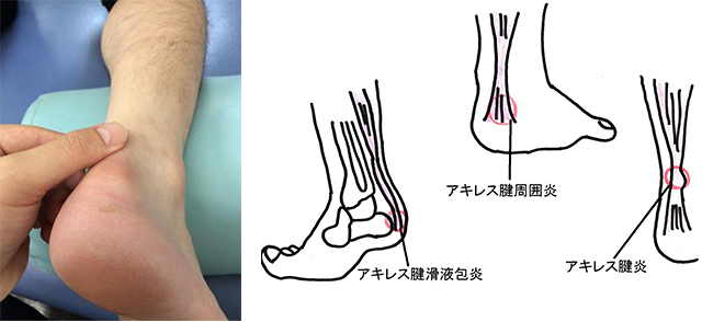 アキレス腱炎・周囲炎ページ