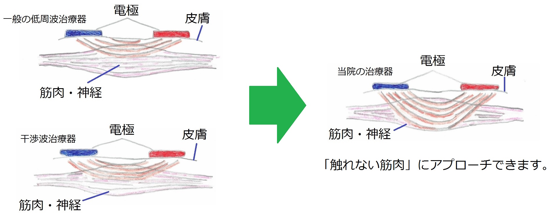 さらに触れない筋肉にもアプローチできます