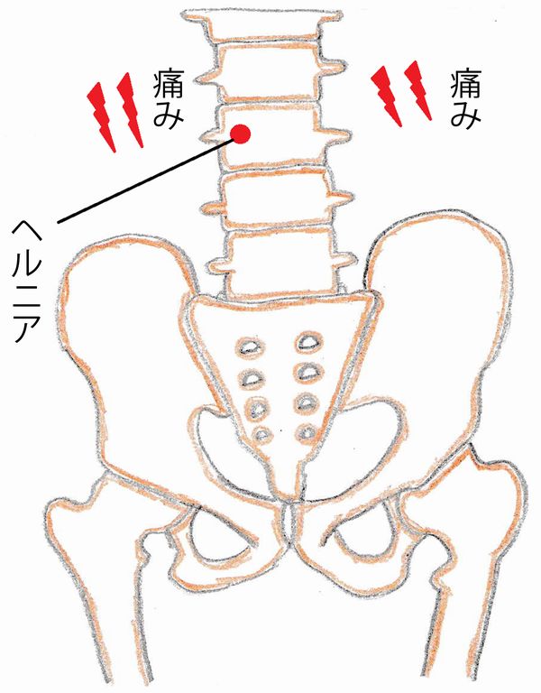 ヘルニア