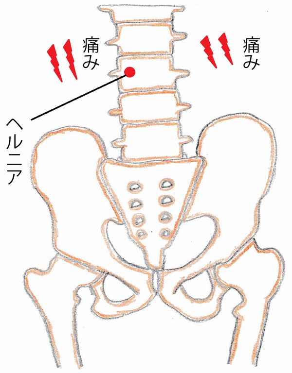 ヘルニア