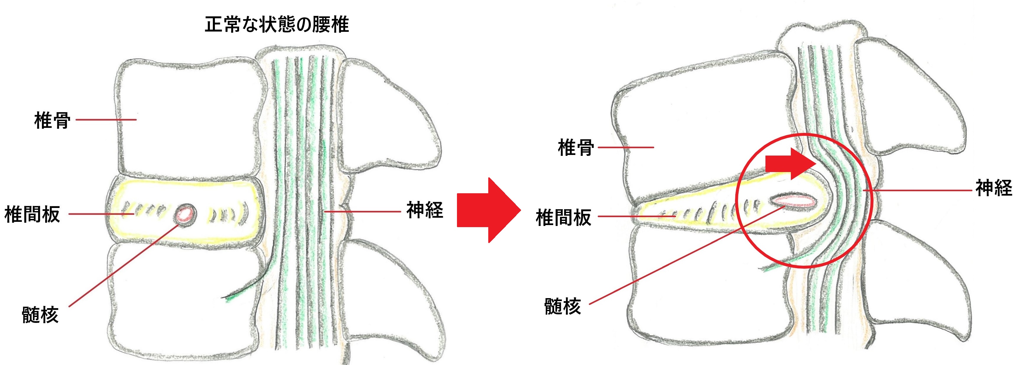 腰椎椎間板ヘルニア
