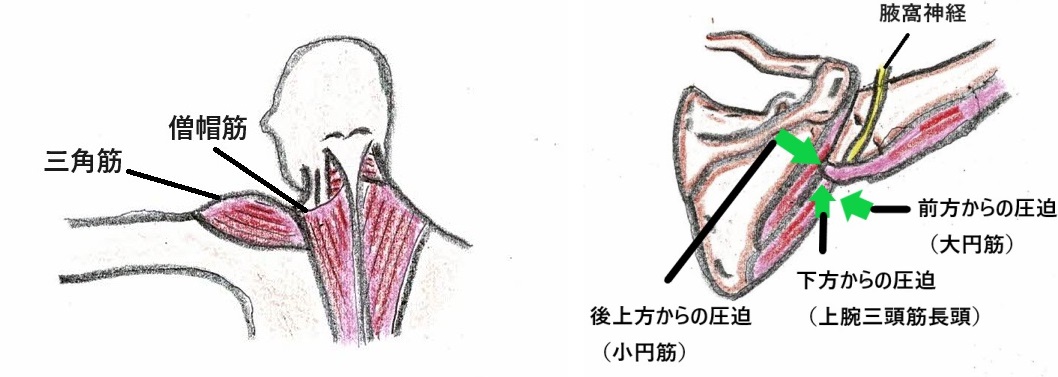 首の寝違え