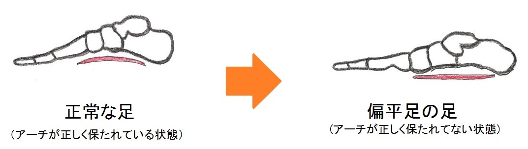 足の指を元に戻して正しく足のアーチを保持する