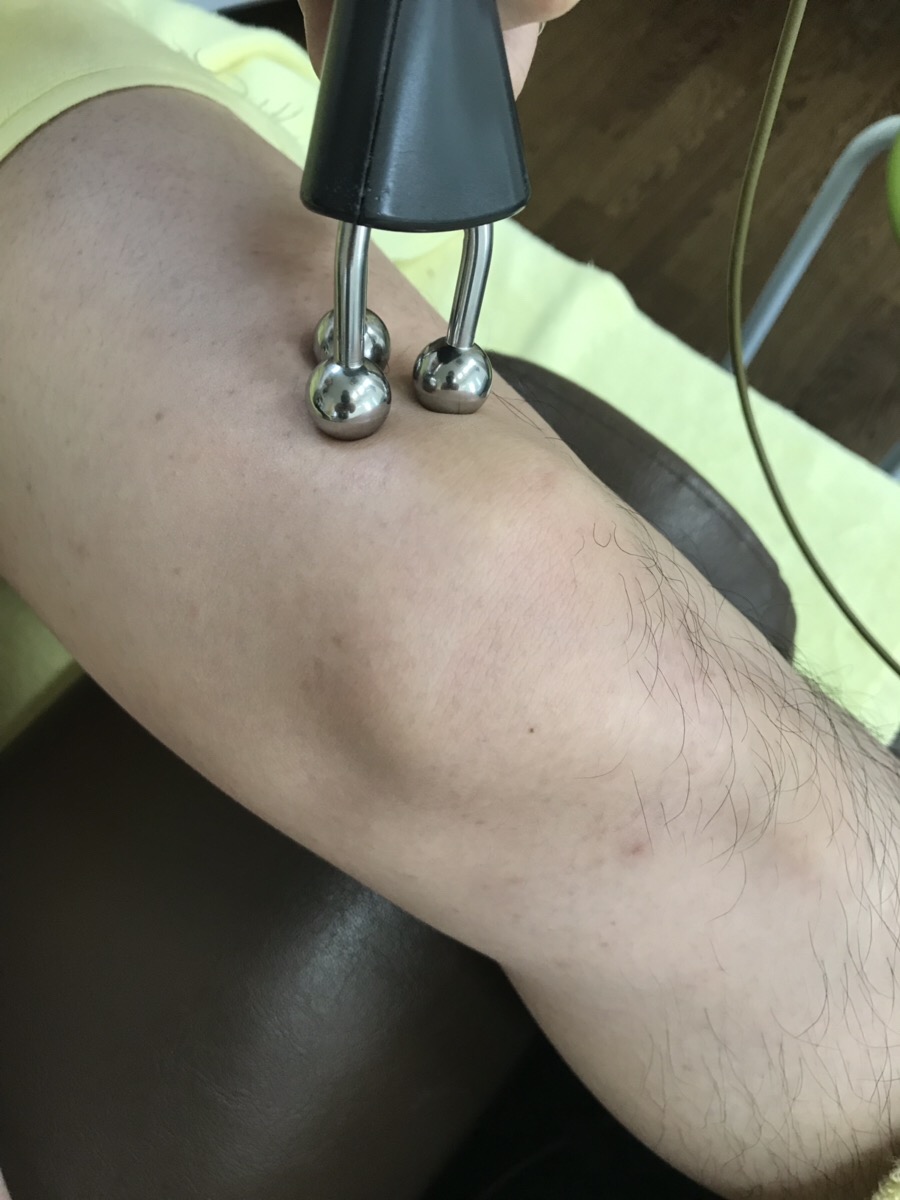 有痛性分裂膝蓋骨には鍼(はり)と電気がオススメ