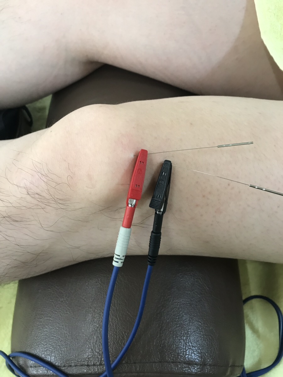 有痛性分裂膝蓋骨には鍼(はり)と電気がオススメ