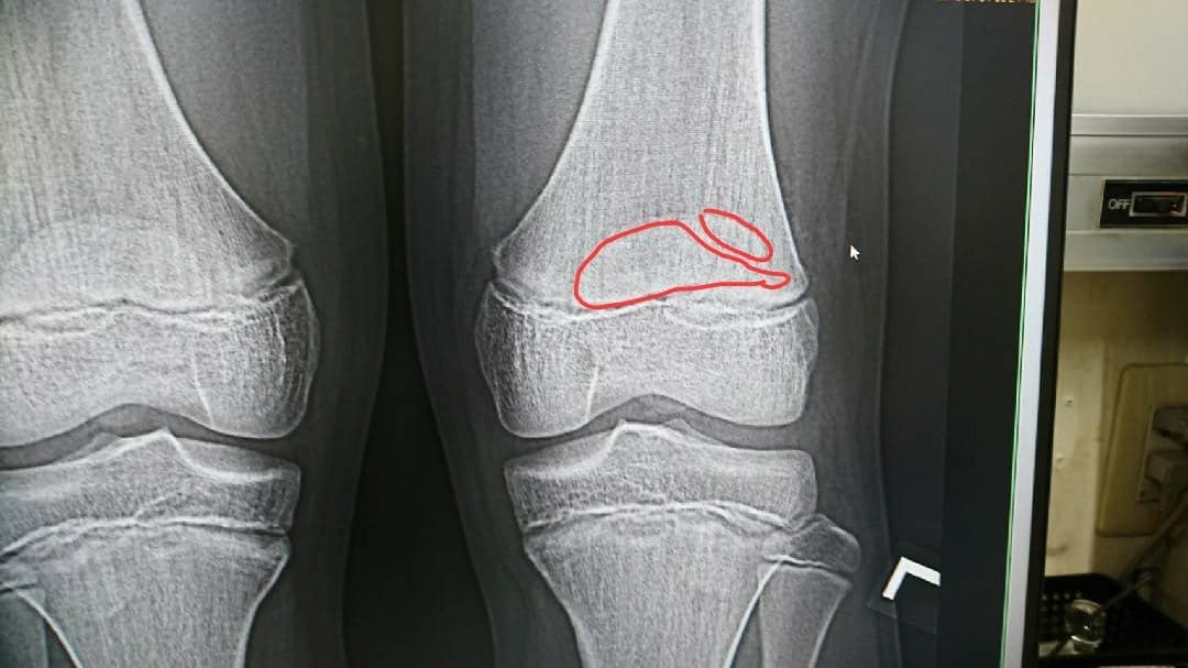有痛性分裂膝蓋骨とは？